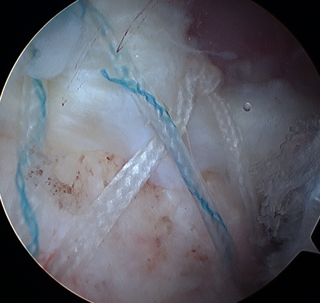 Arthroscopic Suture Bridge Cuff Repair